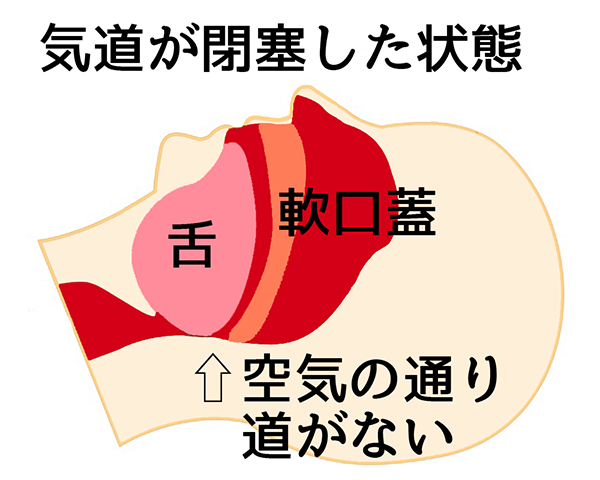 睡眠時無呼吸症候群